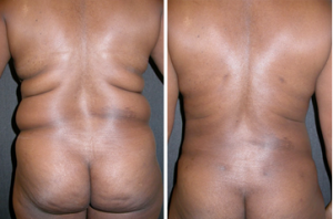 before-and-after-liposuction